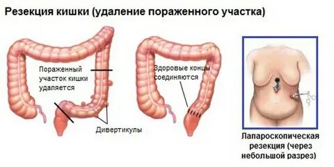 Симптомы операция кишечнике