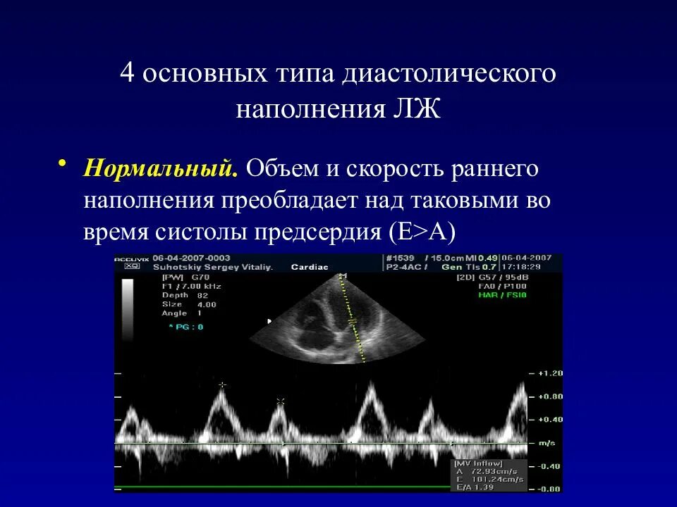 Степени диастолической дисфункции. Диастолическая дисфункция по ЭХОКГ. Типы диастолической дисфункции по данным ЭХОКГ. Диастолическая функция ЭХОКГ. Диастолическая дисфункция левого желудочка на ЭХОКГ.