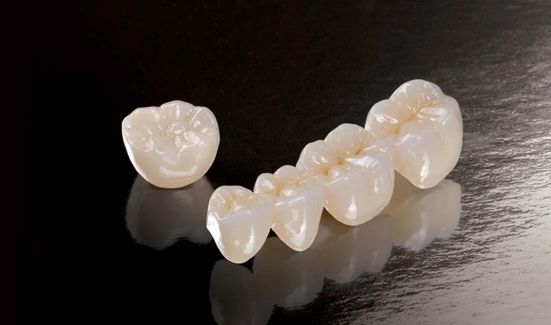 диоксид циркония мостовидный протез. зубной мост из циркония. безметалловая керамика диоксид циркония. Dental zircon crown.