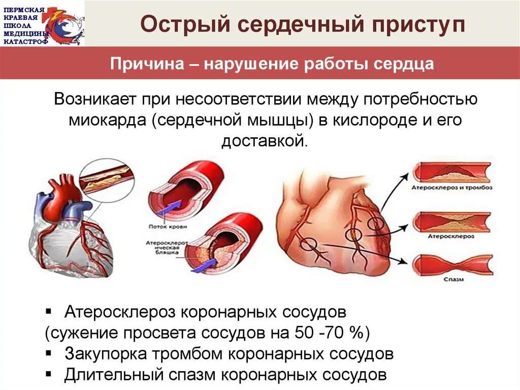 Сердечная недостаточность при инфаркте миокарда. Синдром острой коронарной недостаточности. Симптомы острой сердечной недостаточности (приступ стенокардии). ПМП при острой сердечной недостаточности. Острой сердечной недостаточности презентация.