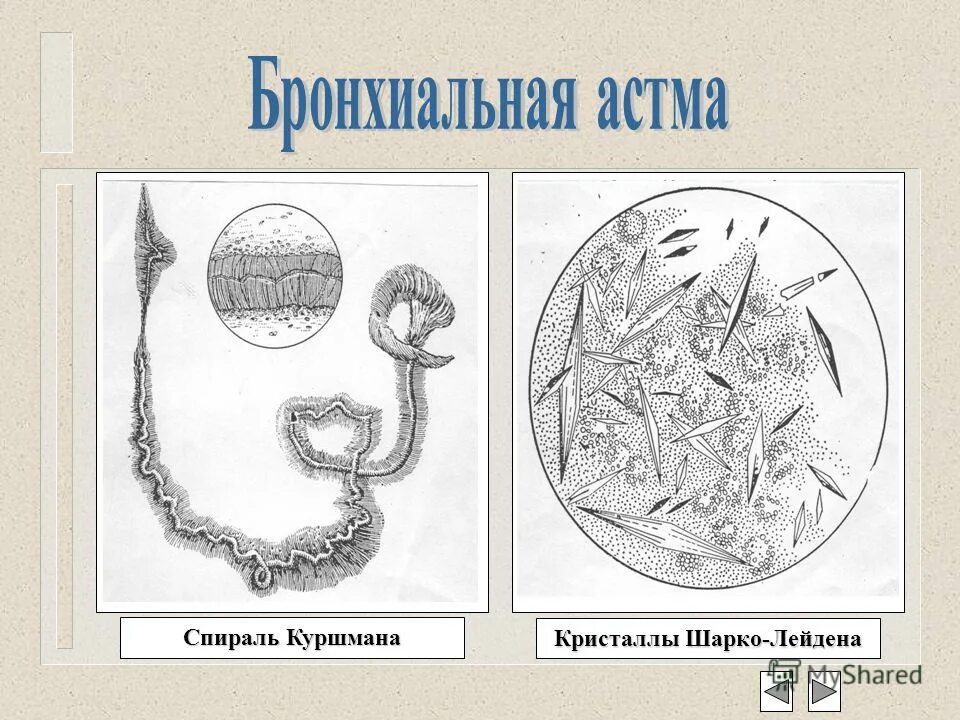 спирали куршмана и кристаллы шарко-лейдена в мокроте. спирали куршмана и кристаллы шарко лейдена. микроскопия мокроты спирали куршмана. спирали куршмана и кристаллы шарко лейдена. спирали куршмана и кристаллы шарко лейдена.