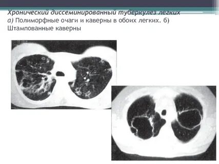 Что значит очаги в легком
