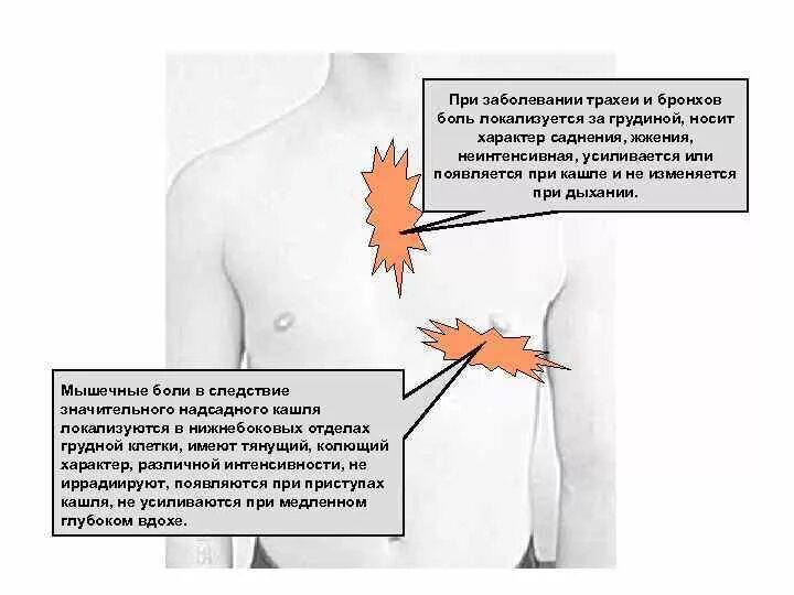 Почему при кашле боль. Побаливает в груди слева. Боль в грудной клетке посередине.