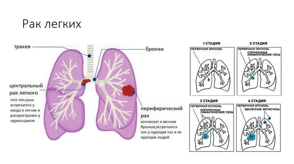 Заболевания левого легкого. Опухоли легких классификация. Центральная опухоль легкого.