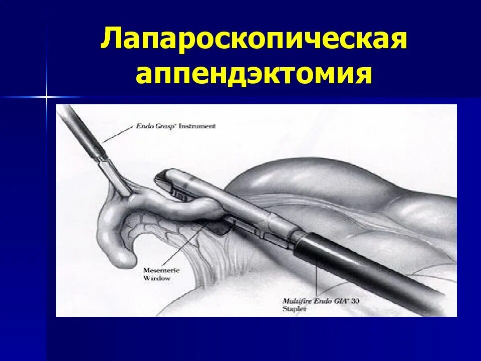 Лапароскопическая аппендэктомия этапы операции. Этапы операции аппендэктомии лапароскопической. Лапароскопическая аппендэктомия техника. Лапароскопическая аппендэктомия ход операции.