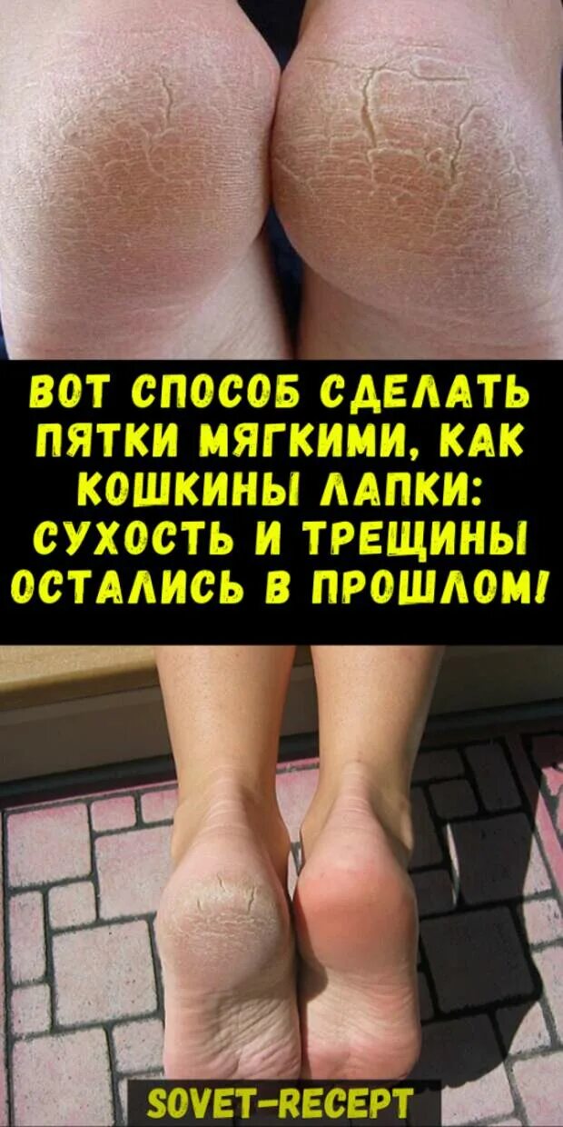 Как сделать пятки мягкими и гладкими. Мягкие пятки. как сделать пятки мягкими. как сделать пяточки мягкими. чтобы были гладкие пяточки.