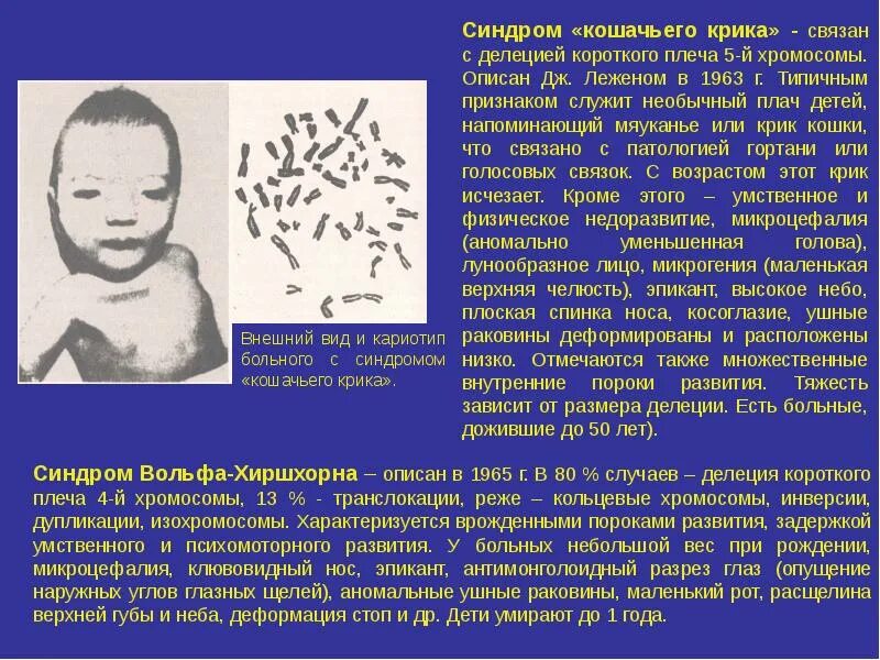Что такое синдром крика. Синдром «кошачьего крика» (делеция короткого плеча 5-й хромосомы). синдром кошачьего крика (делеция в 5-ой хромосоме);. синдром кошачьего крика кариотип. синдром шерешевского тернера кошачьего крика.
