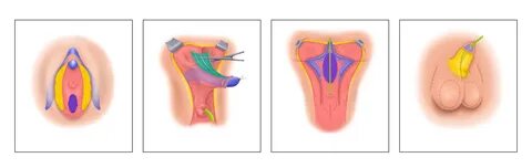 Metoidioplasty - Unlabeled Image.png. 