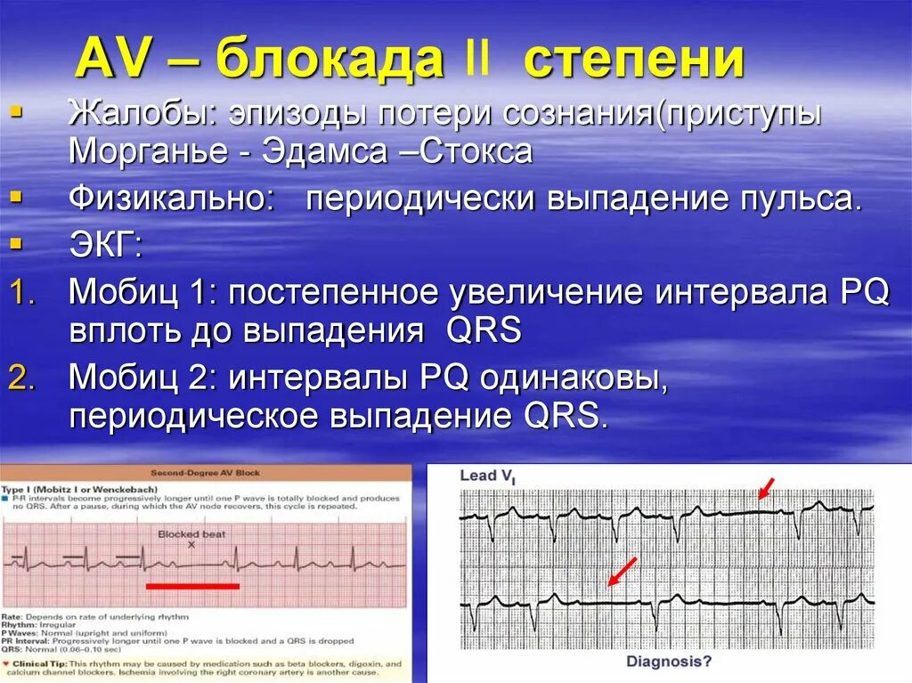 Увеличение интервала pq. Блокада 2 степени ЭКГ Мобиц 2. Av-блокада 111 степени, Мобиц 2.. АВ блокада 2 степени жалобы. Атриовентрикулярная блокада Мобиц 1 ЭКГ.