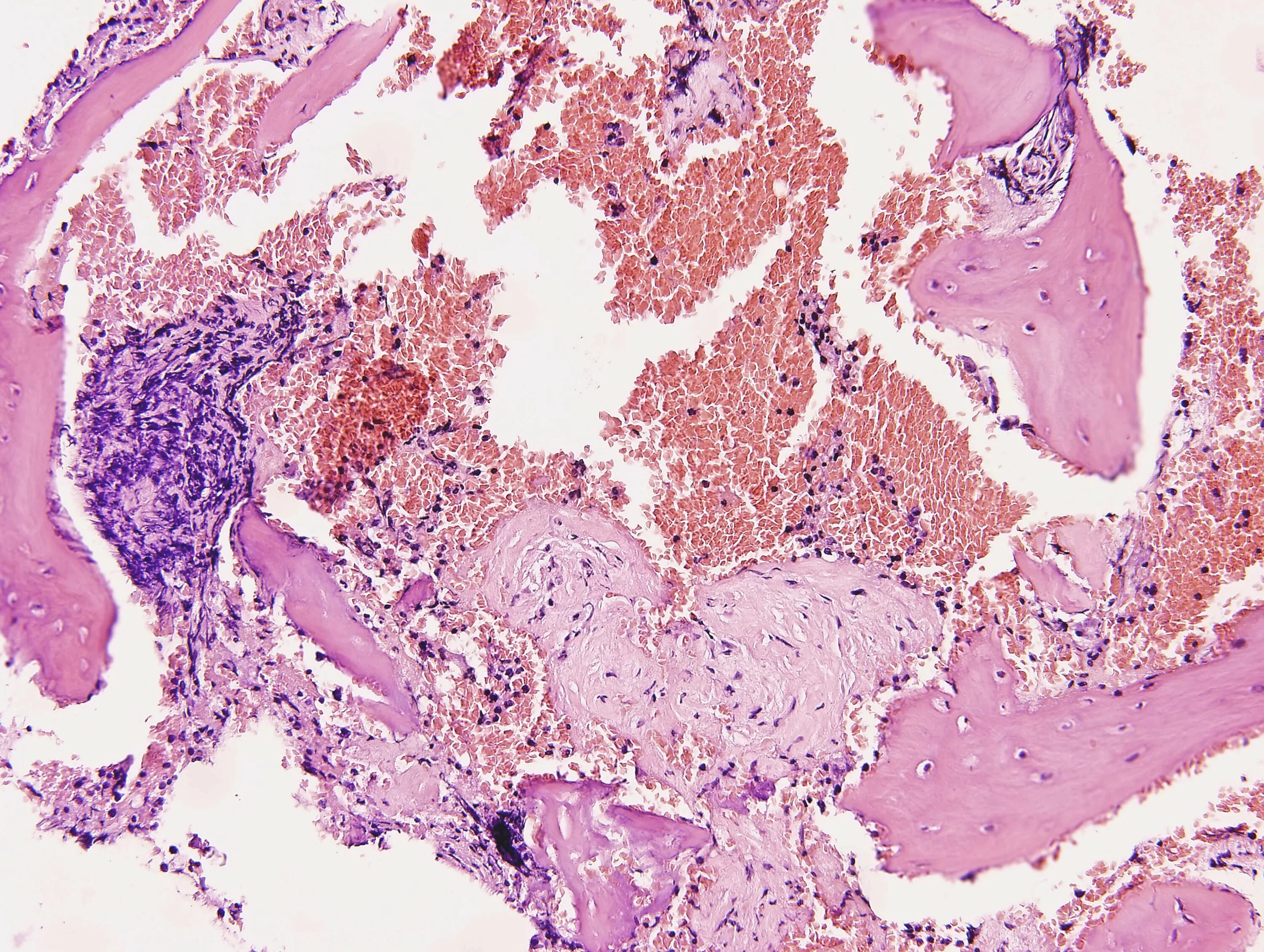Миелофиброз гистология. Гистология фиброзные фрагменты. Фиброзная дисплазия микропрепарат. Паратиреоидная остеодистрофия патологическая анатомия. Фиброзная дисплазия костей гистология.