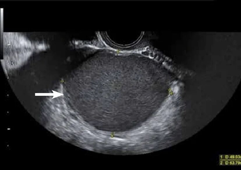 Киста яичника orads. Эндометриоидная киста яичника на УЗИ. Эндометриоидная киста УЗИ картина. Эндометриоидная киста яичника УЗИ картина.