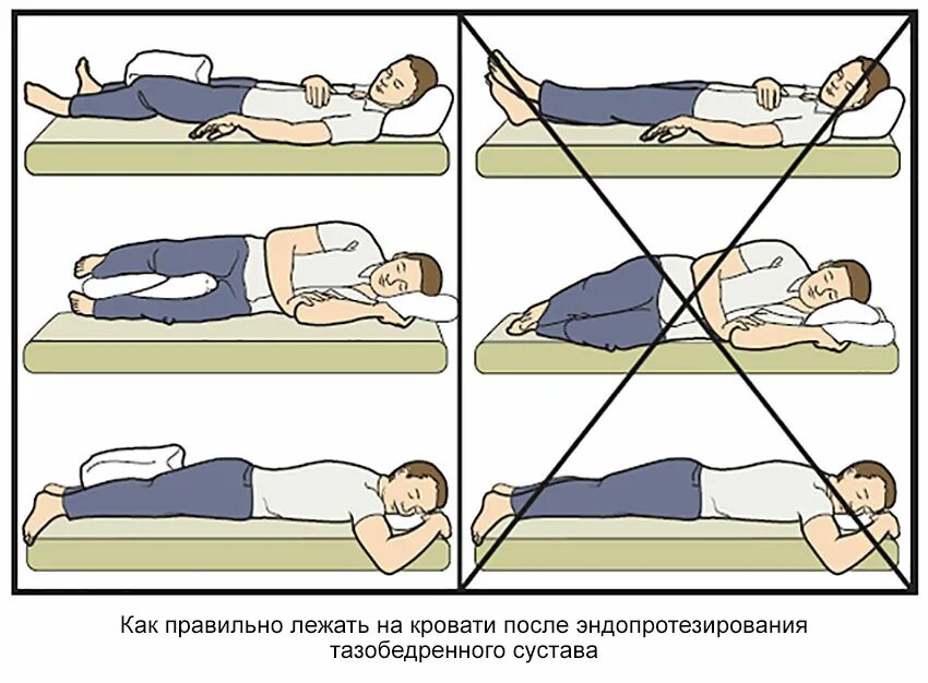 Как спать после удаления. Гимнастика после эндопротезирования тазобедренного сустава. Как правильно лежать. Правильное положение для сна. Положение при сне.