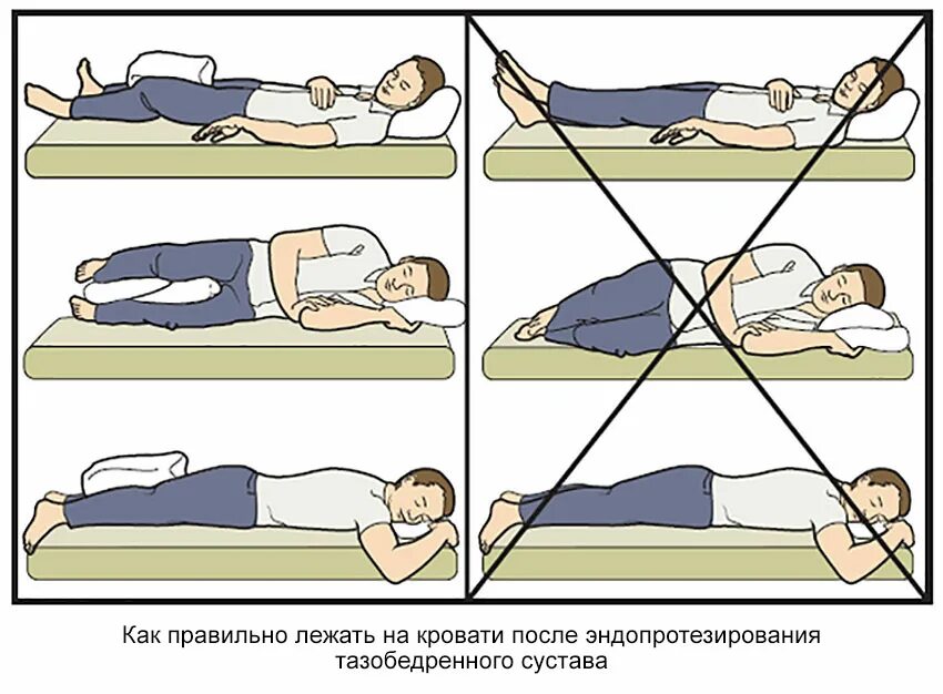 Гимнастика после эндопротезирования тазобедренного сустава. Как правильно лежать. Правильное положение для сна. Положение при сне. Можно ли пить лежа