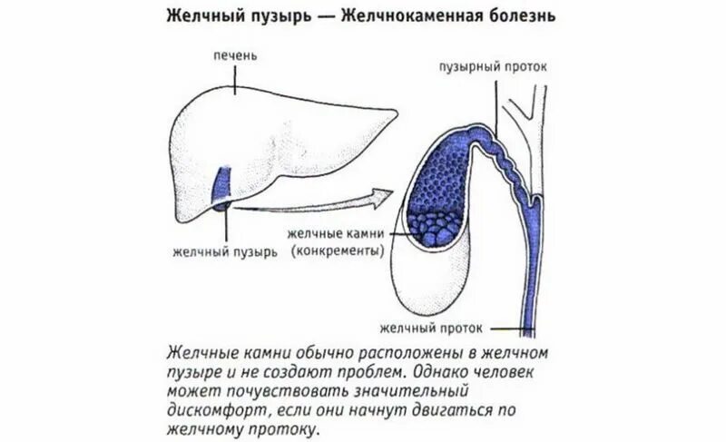 Симптомы желчного пузыря форум