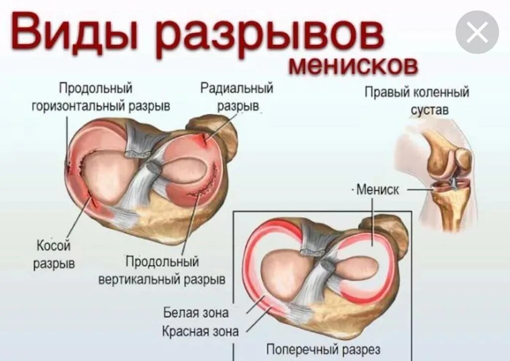 Внутренний медиальный мениск. Повреждение внутреннего мениска коленного сустава. Рога мениска коленного сустава. Мениски коленного сустава анатомия разрыв. Поврежденный мениск коленного сустава