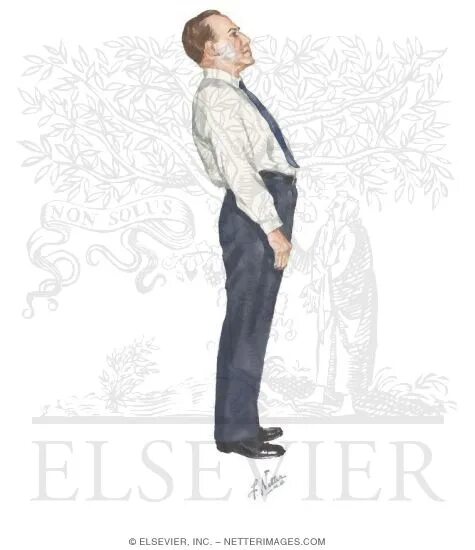 Синдром ригидного человека. Паркинсонизм акинетико ригидная форма. Акинетико-ригидный синдром симптомы. Синдром ригидного человека. Синдром ригидного человека.