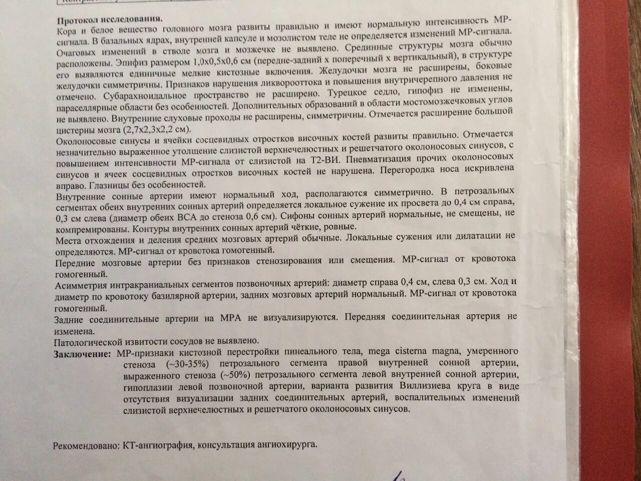 Развитие виллизиева круга в виде отсутствия кровотока. Варианты развития Виллизиева круга. Развитие Виллизиева круга в виде задних соединительных артерий. Отсутствие кровотока по задним соединительным артериям. Отсутствие кровотока по левой задней соединительной артерии.