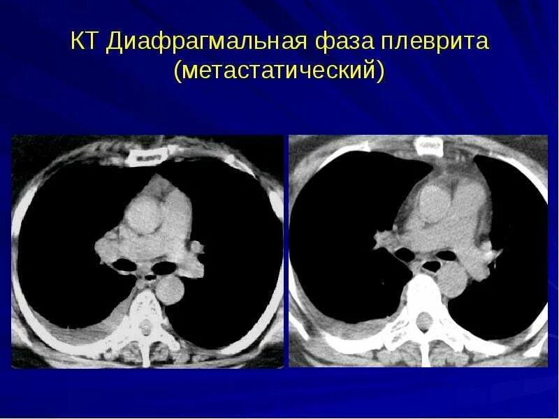 Выпот плевральной полости снимок. Осумкованный плеврит на кт. Туберкулезный плеврит кт. Осумкованный плеврит на кт. Плеврит и гидроторакс на рентгене.
