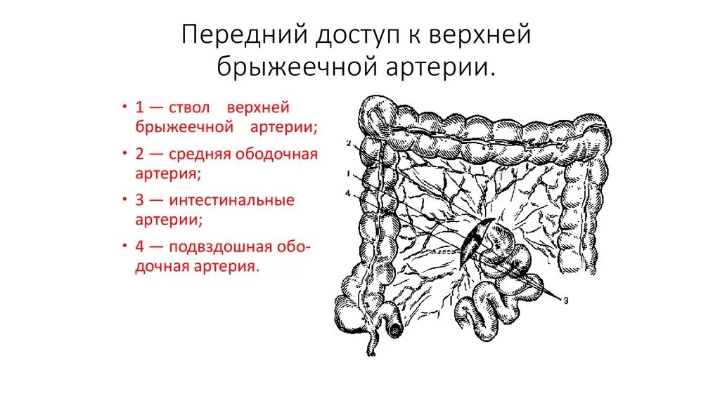 Сегменты тромбоза верхней брыжеечной артерии. Сегменты верхней брыжеечной артерии. Тромбэктомия из верхней брыжеечной артерии. Доступ к верхнебрыжеечной артерии. Острое мезентериальное кровообращение