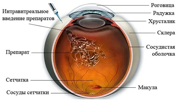 Интравитреальная инъекция. Интравитреальное Введение ингибиторов ангиогенеза. Интравитреальное Введение Луцентиса. Введение Луцентиса в глаз. Введение интравитреальное Введение.