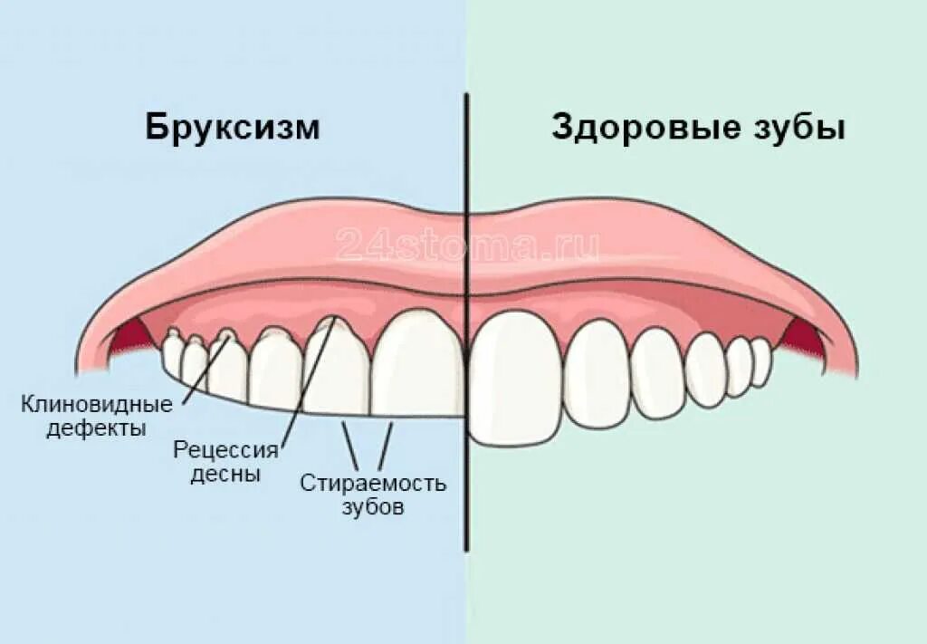 Почему скрипишь зубами ночью во сне. Почему скрипишь зубами ночью во сне