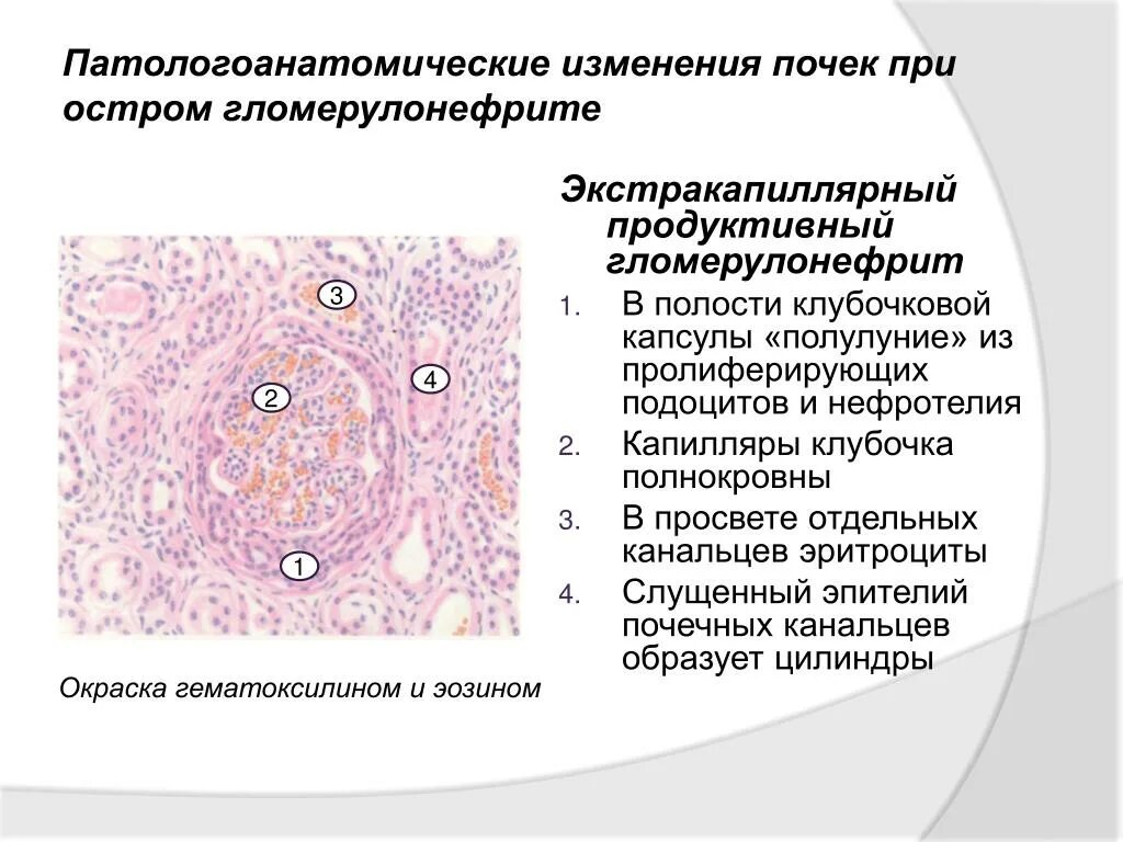 Пиелонефрит микропрепарат. Интракапиллярный гломерулонефрит микропрепарат. Экстракапиллярный продуктивный гломерулонефрит макропрепарат. Интракапиллярный продуктивный гломерулонефрит. Описание микропрепарата экстракапиллярный гломерулонефрит.