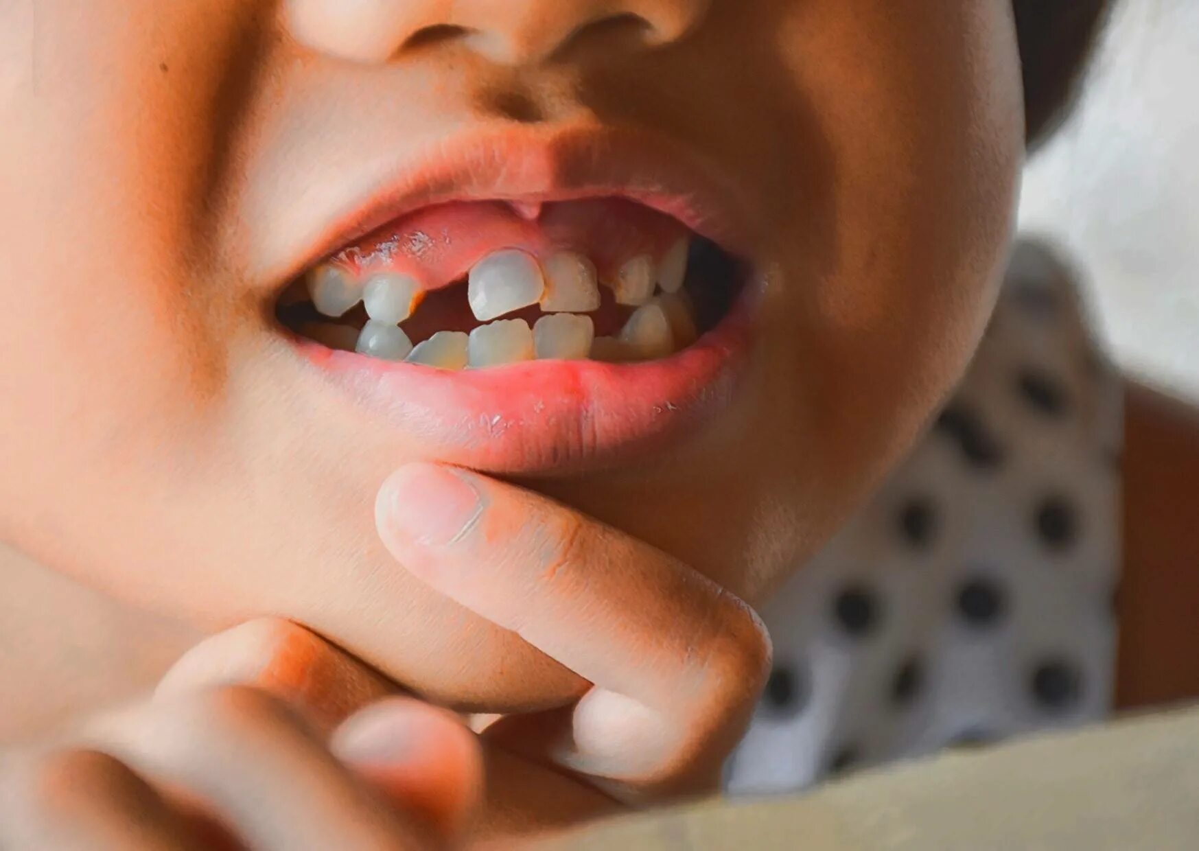 Ребенок год скрежет зубами. Крошение зубов у детей.