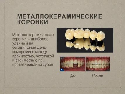 Металлокерамические зубы отзывы