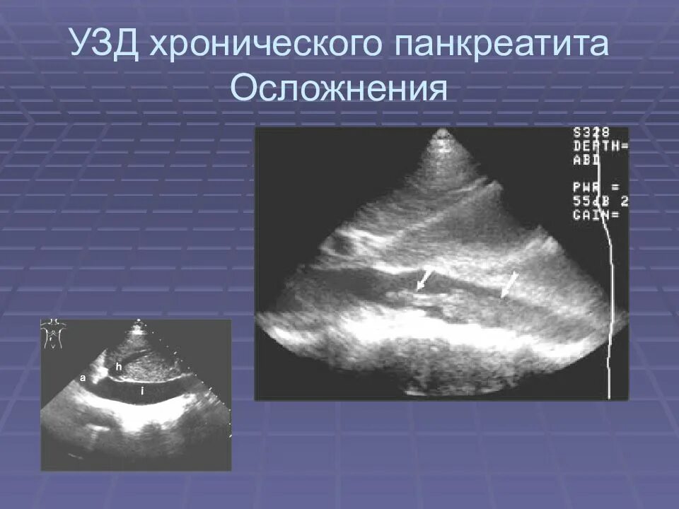 Осложнения поджелудочной железы. УЗИ поджелудочной железы панкреатит. Острый панкреатит на УЗИ. УЗИ поджелудочной железы хронический панкреатит. Хронический панкреатит УЗИ.