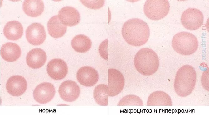 Пониженные макроциты. Гипохромия и гиперхромия. Гиперхромная микроцитарная анемия. Макроцитоз гиперхромия анемия. Гиперхромная анемия мазок крови.