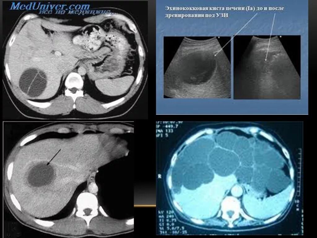 Кисты печени и почек. Билиарная киста печени кт. Эхинококковая киста печени кт. Многокамерная киста печени.