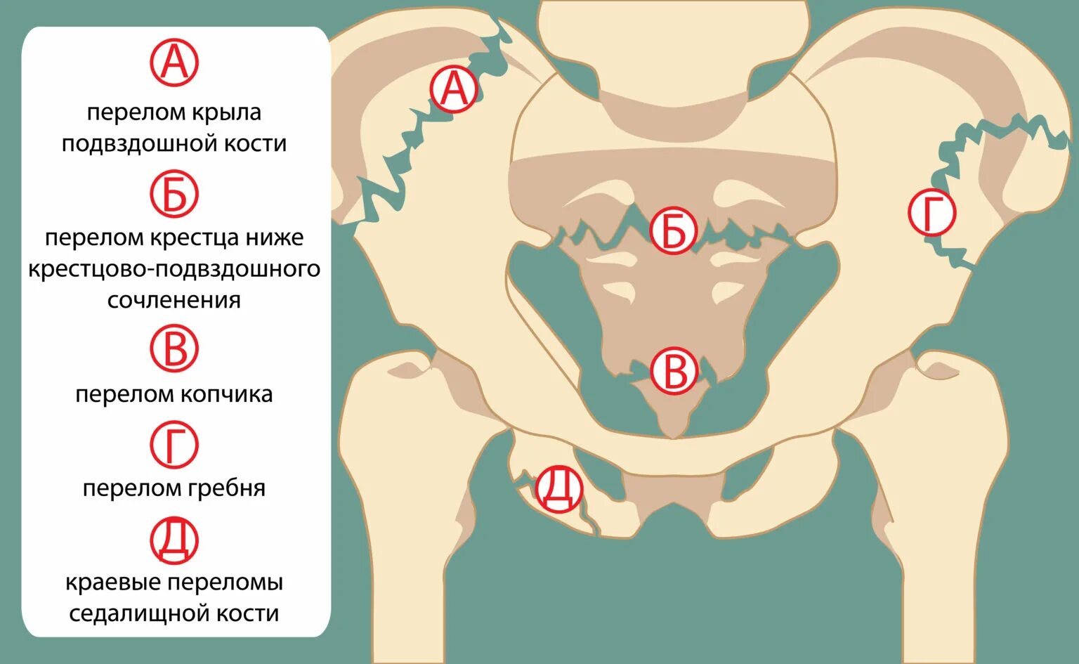 Болят кости после операции. Подвздошная кость малого таза. Стабильные переломы костей таза.