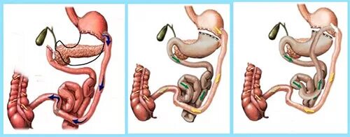 Операция желудка кишечника. Лапароскопическая резекция желудка. Резекция желудка для похудения. Операция на желудок для похудения. Операция по уменьшению желудка.