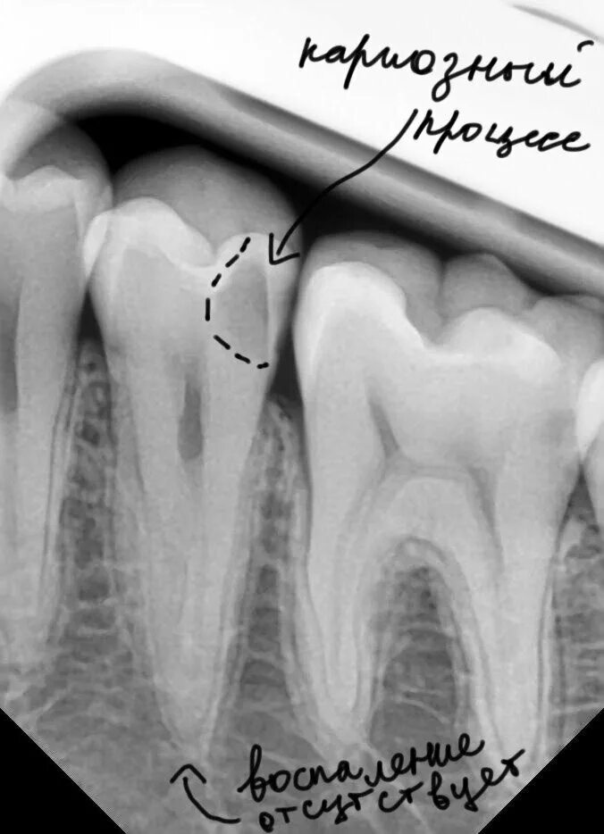 Снимок зубов видное. Фиссурный кариес рентген. Периапикальный периодонтит. Ортопантомограмма кариес.