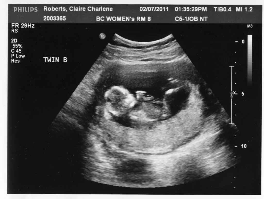 17 неделя беременности что есть. Снимок УЗИ 15 недель беременности. УЗИ 16 недель беременности. Плод на 17 неделе беременности.
