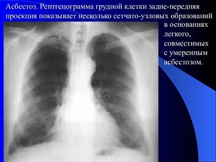 Асбестоз легких