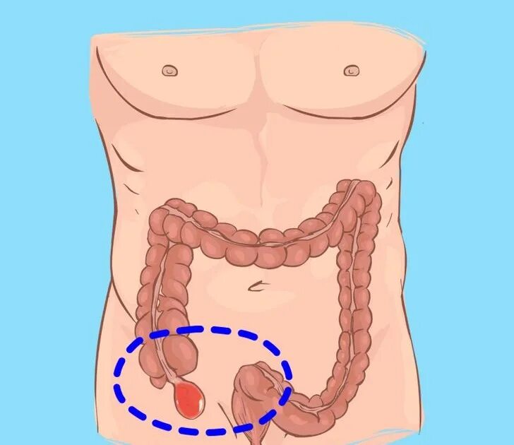 Червеобразный аппендицит. Червеобразный отросток толстой кишки.