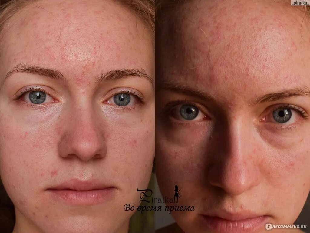 Реакция на витамин д. Аллергическая сыпь на лице. Сыпь на лице от витаминов. Аллергическая реакция на коже лица.