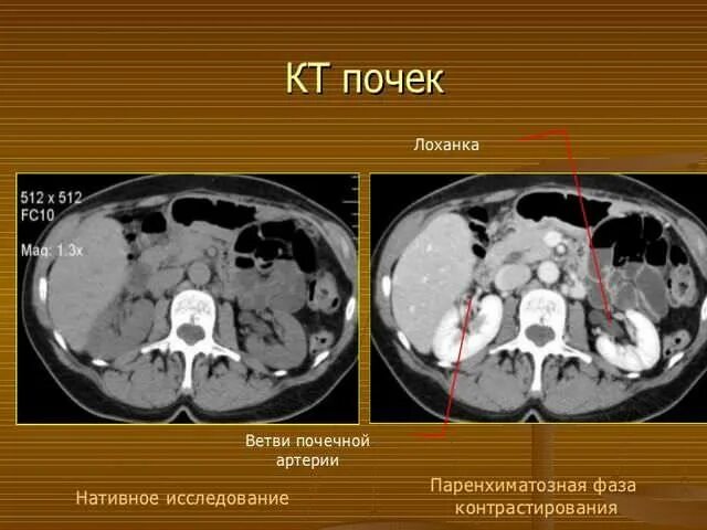 Можно по кт определить. Контрастирование почек кт. Кт естественное контрастирование. Кт забрюшинного пространства (почки и надпочечники). Кт почек с болюсным контрастированием.