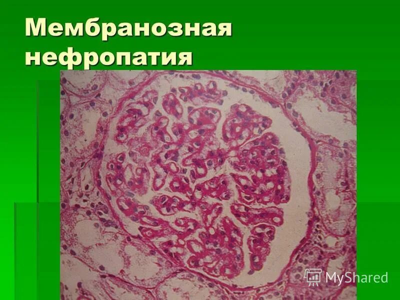 нефропатия форум. нефропатия форум. мембранозной нефропатии морфология. диабетическая нефропатия. нефропатия форум.