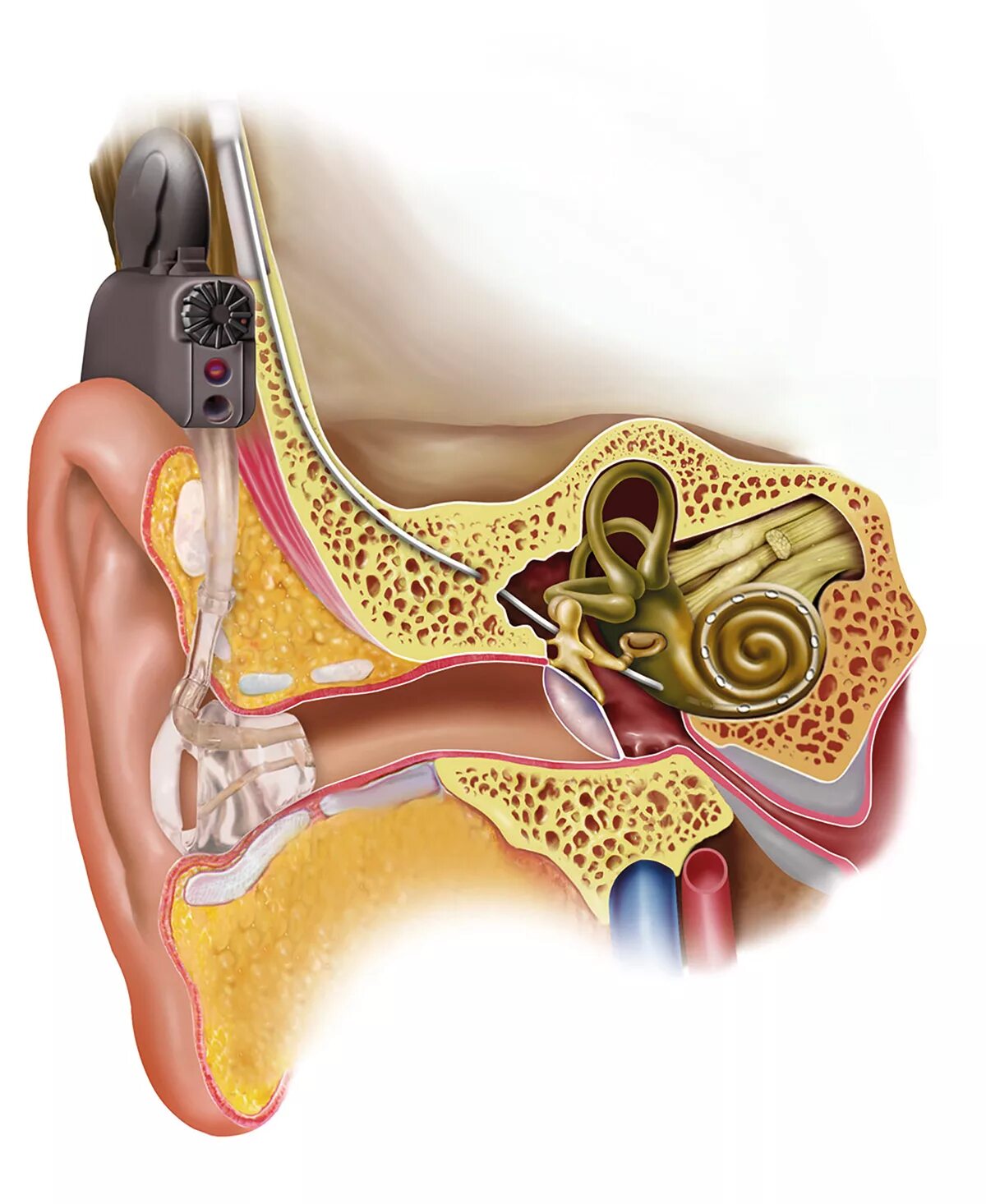 Кохлеарная имплантация строение уха. Серная пробка на барабанной перепонке. Наружный отит барабанная перепонка.