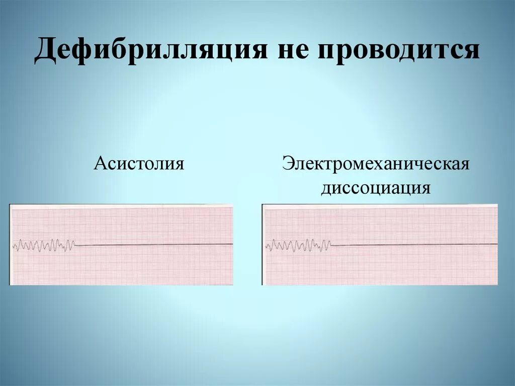 Дефибрилляция при асистолии. Электромеханическая диссоциация на экг. асистолия дефибрилляция. электромеханическая диссоциация дефибрилляция. асистолия дефибриллятор.
