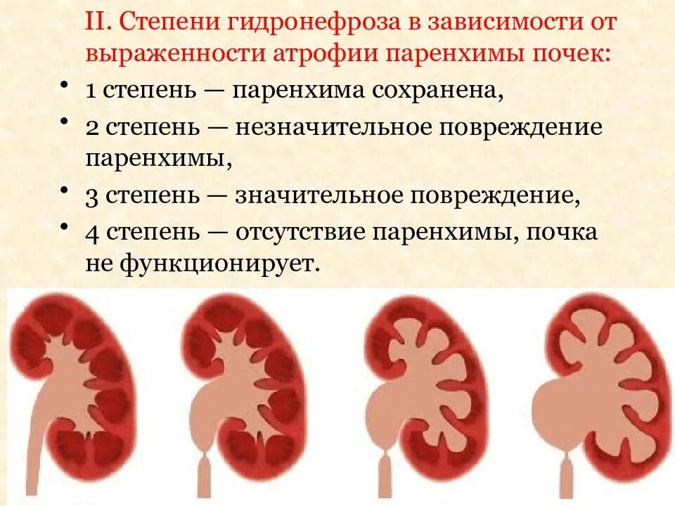 Признаки члс. Пиелонефрит 2 степени гидронефроз. Гидронефроз 2 2 степени.