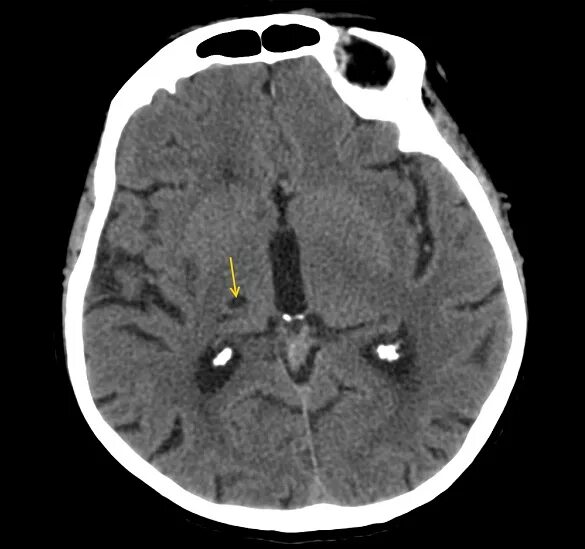 Лакунарная киста головного мозга на кт. Постгеморрагическая киста головного мозга. Постгеморрагическая киста головного мозга кт. Киста головного мозга на кт. Постишемические кисты мозга