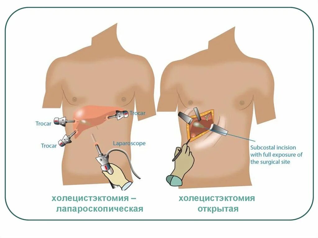 Месяц после холецистэктомии. Этапы операции холецистэктомии. Лапароскопическая холецистэктомия. Лапароскопическая холецистэктомия разрезы. Лапароскопическая холецистэктомия этапы.