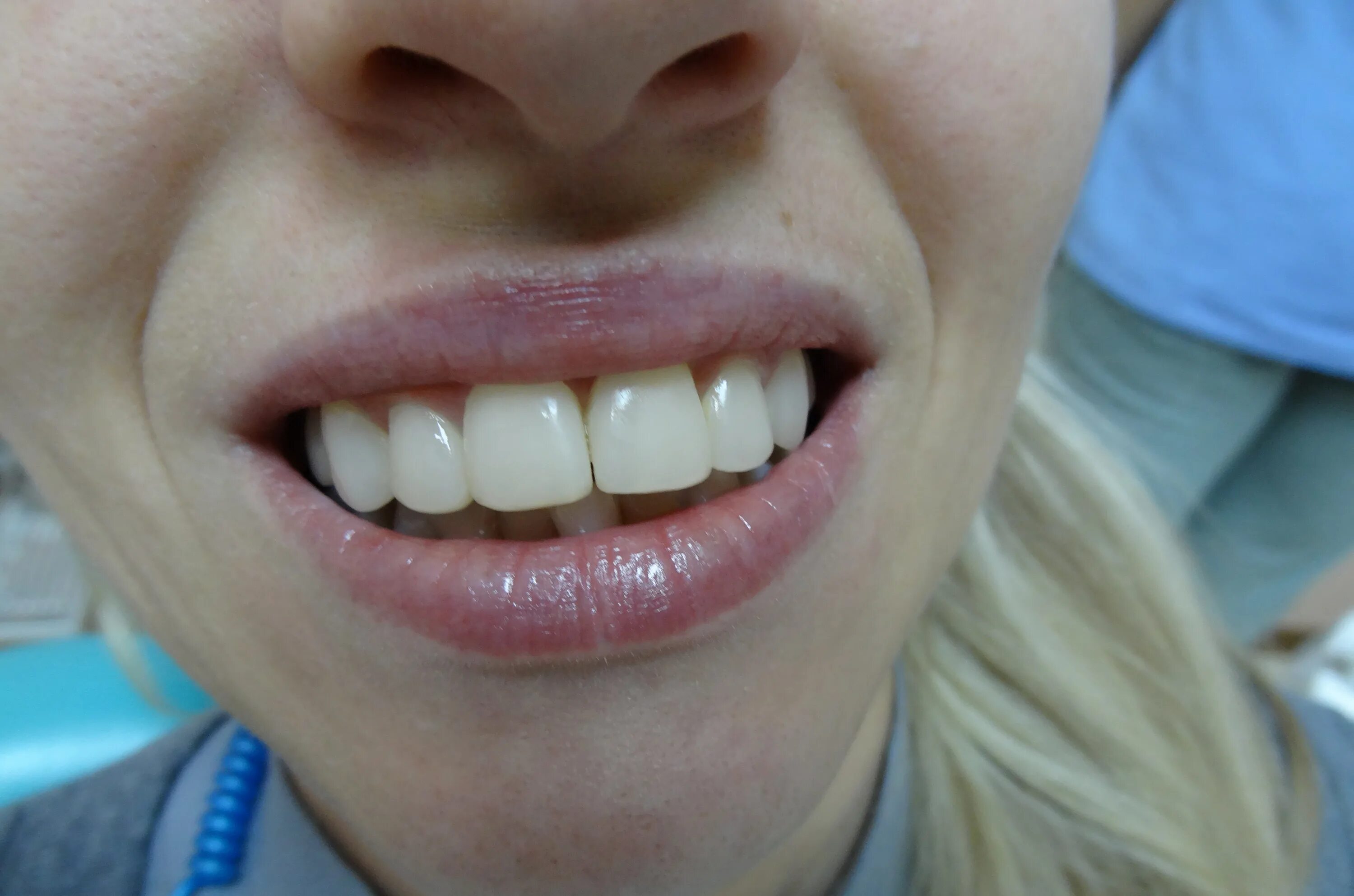 Два передних. Два передних. Исправление кривых зубов винирами. Ровные зубы. Композитные виниры componeer.