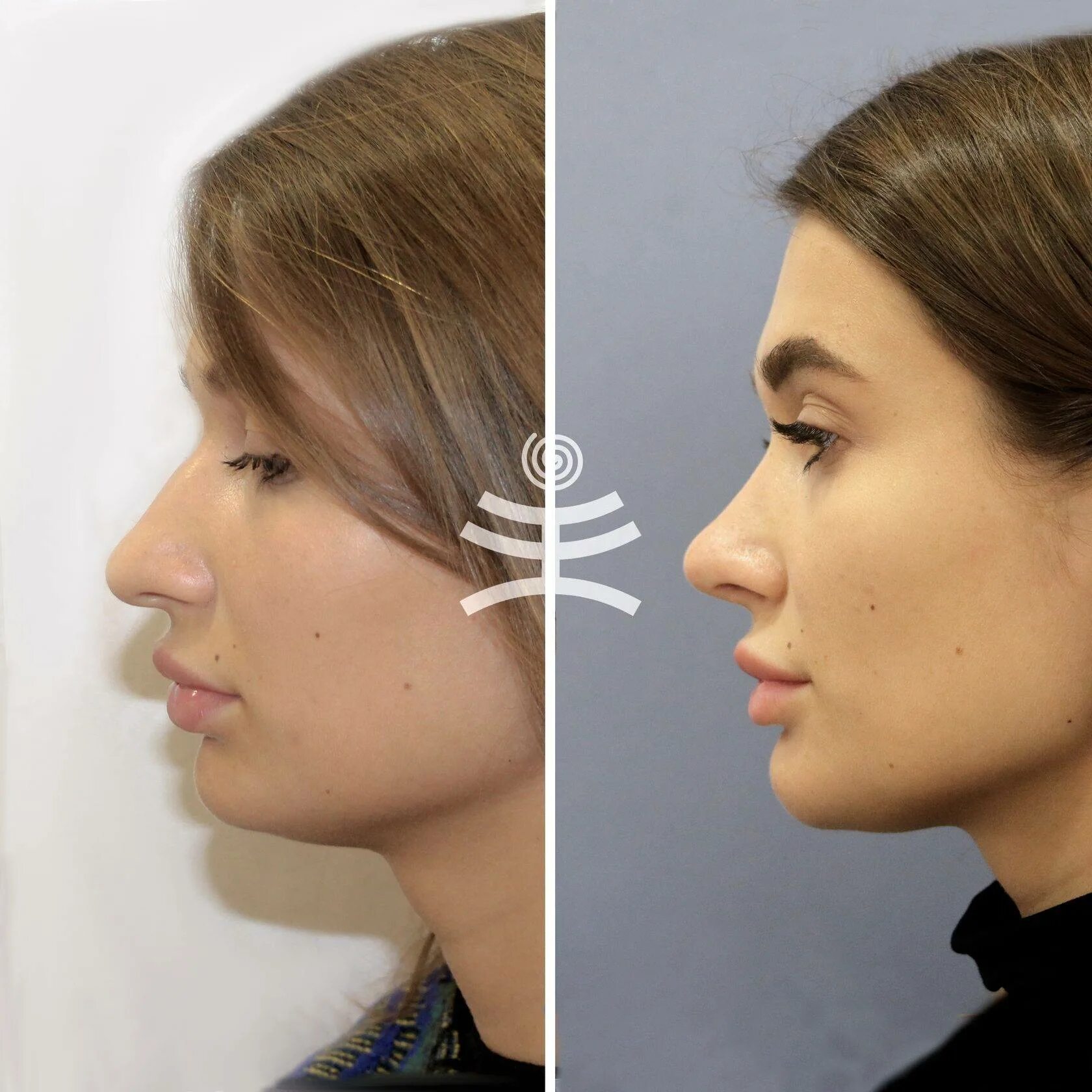 курносый нос. ринопластика длинного носа. маленький длинный нос. хайбула камилович ринопластика. пенопластика курносый нос.