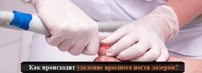 Лазер брови. Лис лазерный аппарат. Лазерная косметология реклама. Эндосфера аппарат. Лазерное удаление макет рекламы.