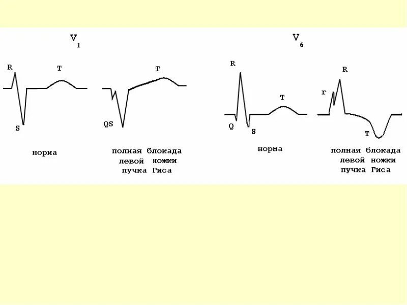 Признаки блокады левой ножки пучка гиса. Экг критерии блокады левой ножки пучка гиса. Блокада пнпг и передней ветви лнпг на экг. Острая блокада левой ножки пучка гиса. Острая блокада левой ножки пучка гиса.