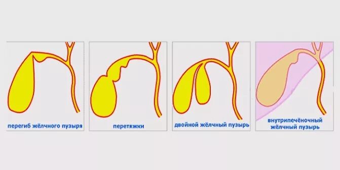 Признаки перегиба желчного пузыря